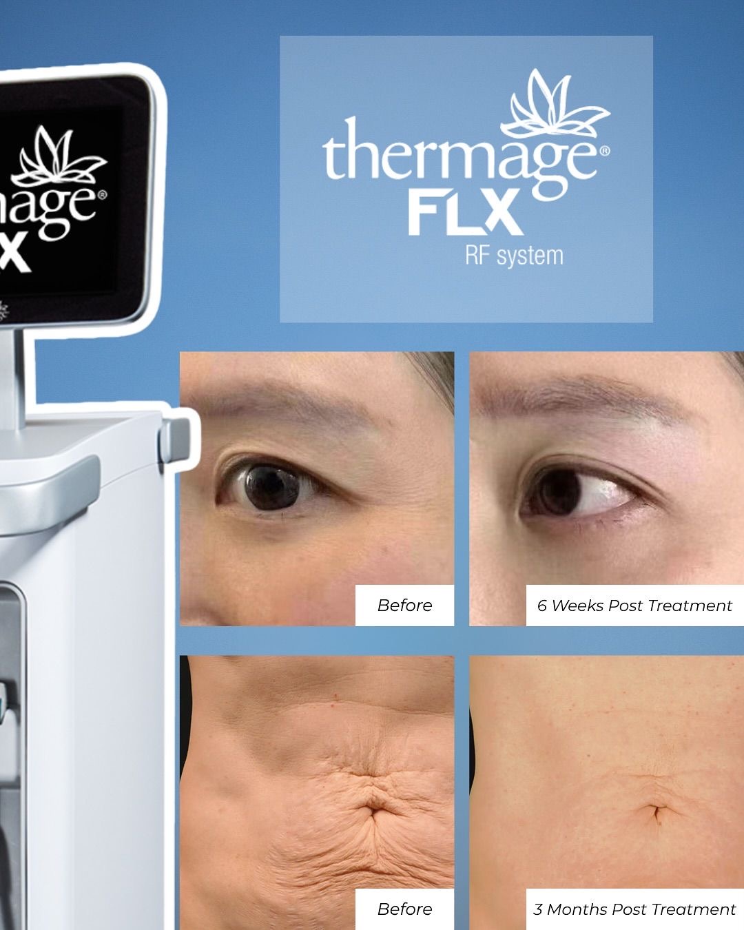 Thermage 治疗前后对比