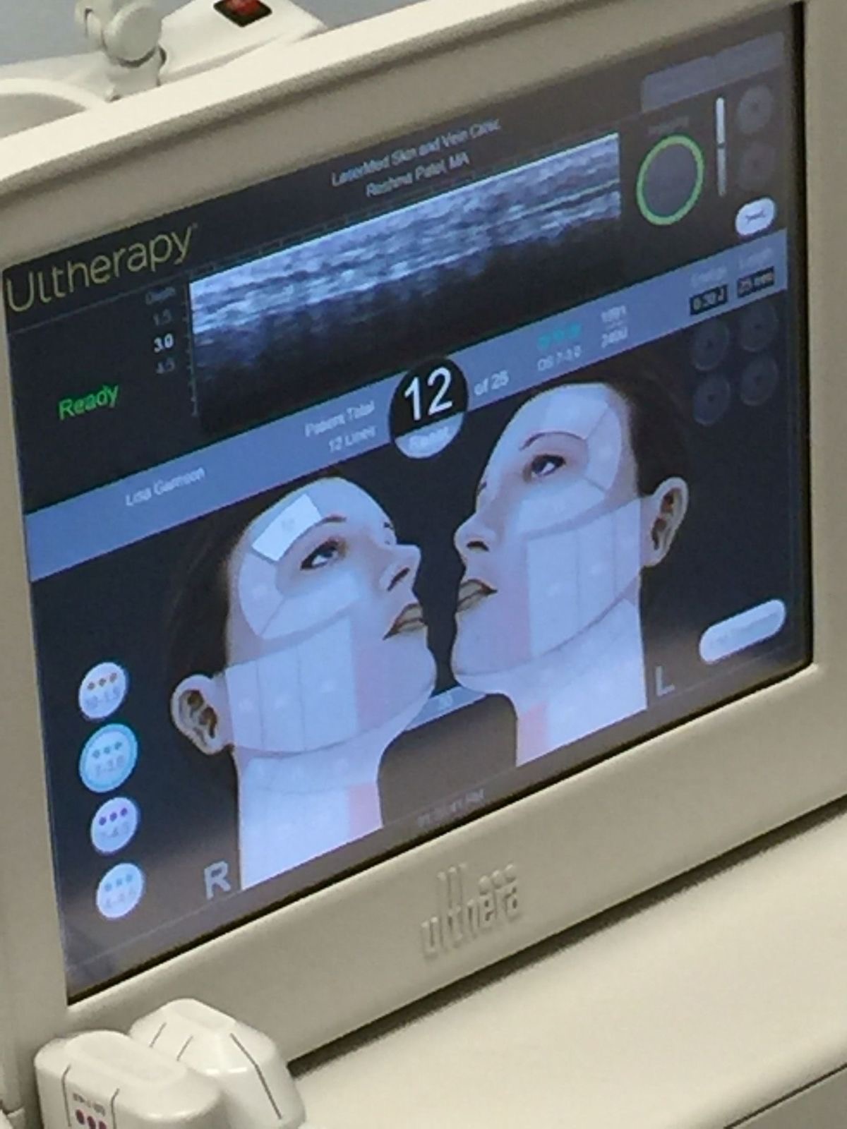 DeepSEE 實時超聲波影像