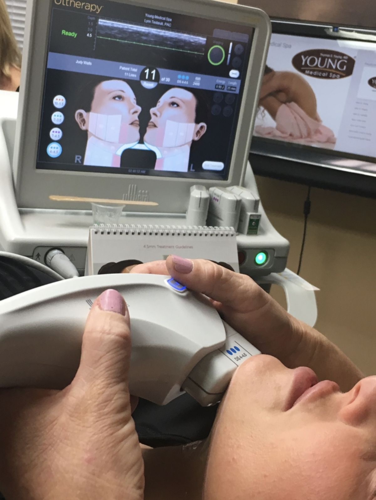 Ultherapy 頸部療程