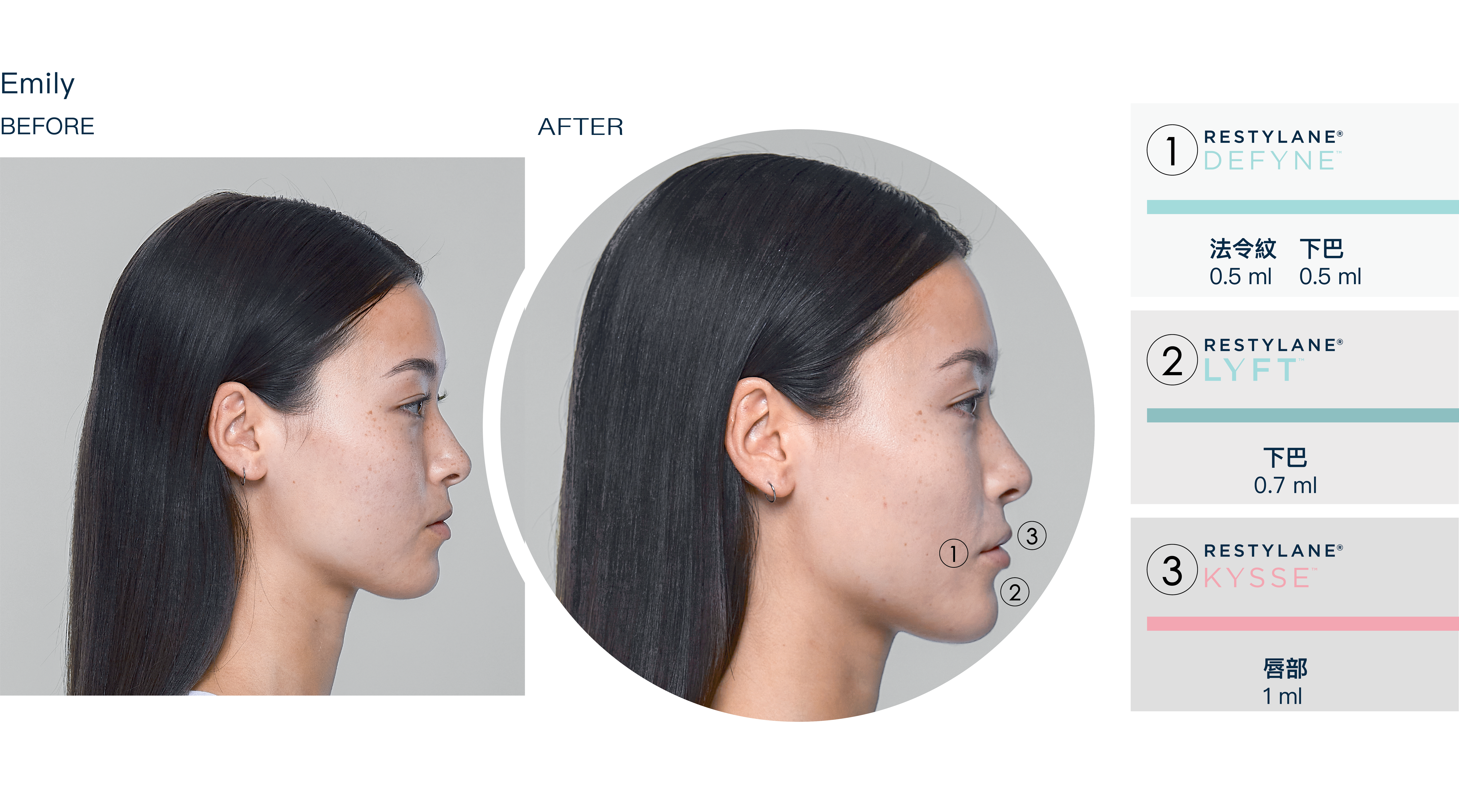 法令紋改善效果